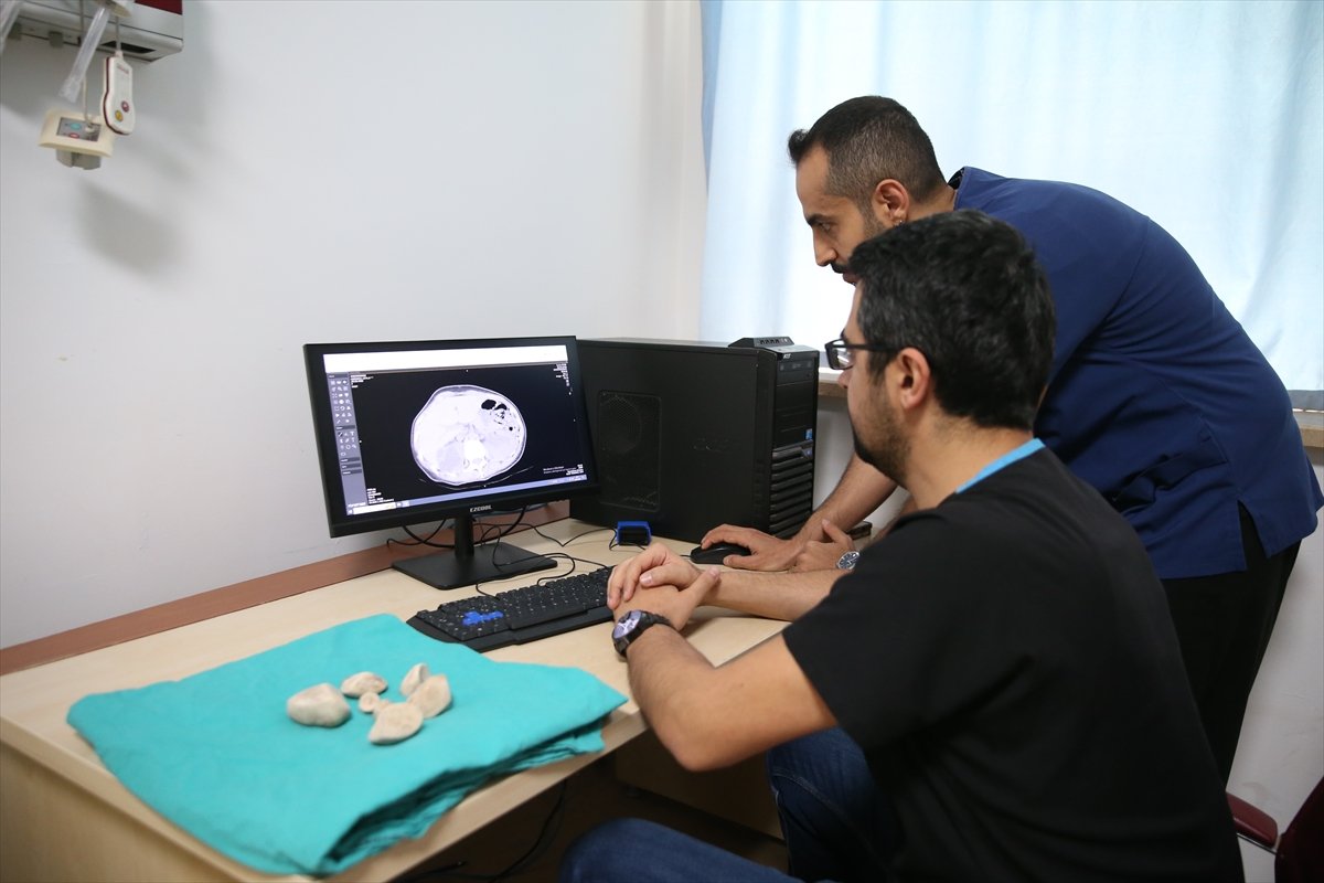 İdrar kanalı ve mesanesinden yarım kilogram ağırlığında 6 taş çıkarıldı
