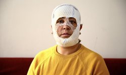 Adana'da cilt bakımı sonrası yüzünde yanık oluştuğunu iddia eden kadın şikayetçi oldu