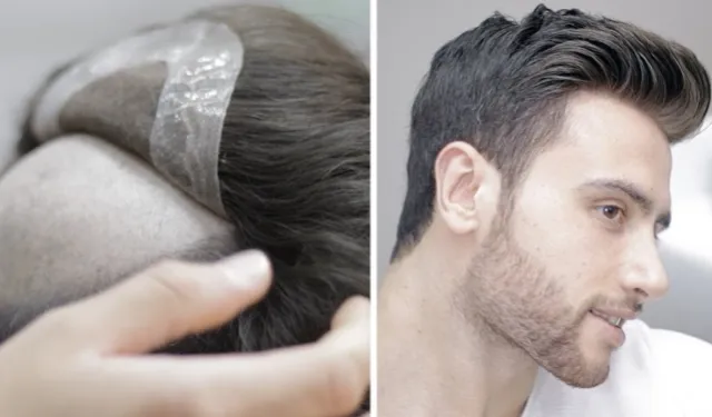 Uzmanından protez saç kullanacaklara tavsiyeler